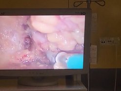 Innowacyjny zabieg w szpitalu Matki Polki w Łodzi. Nadzieja dla kobiet z rakiem piersi