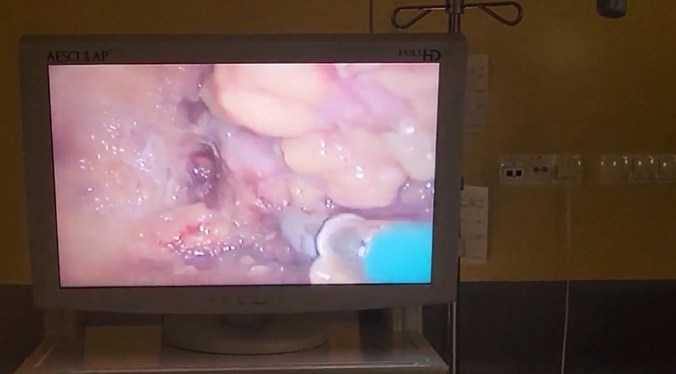 Innowacyjny zabieg w szpitalu Matki Polki w Łodzi. Nadzieja dla kobiet z rakiem piersi