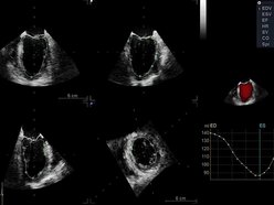 Łódź. Nowoczesny echokardiograf na Uniwersytecie Medycznym w Łodzi. Lepsza diagnostyka i leczenie
