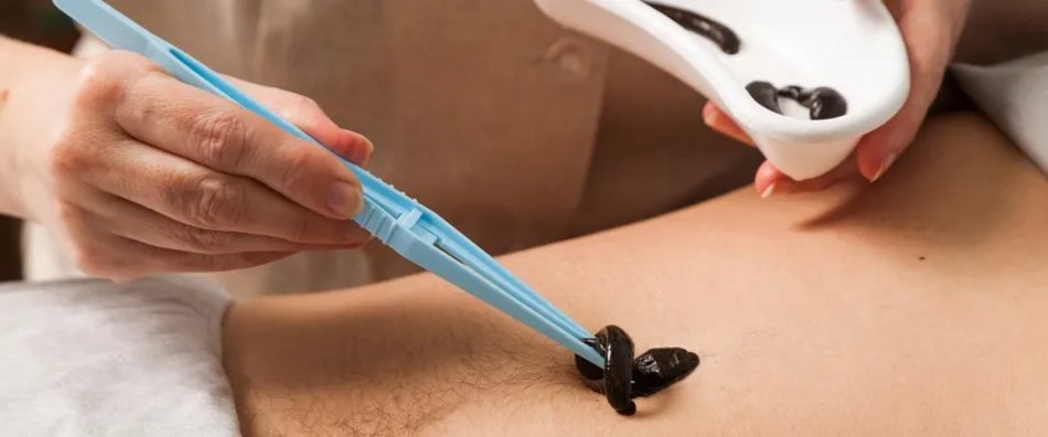 Łódź. Terapia pijawkami w przychodni w Łodzi. Na czym polega hirudoterapia?