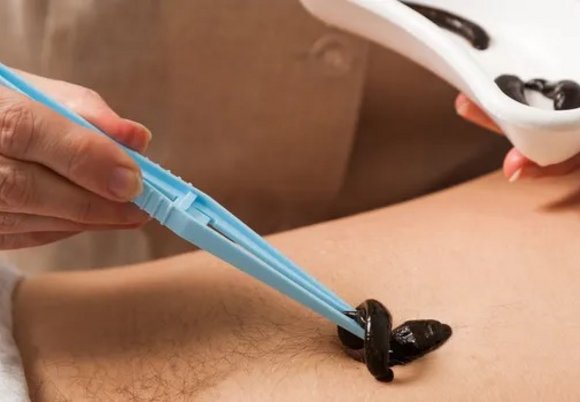 Łódź. Terapia pijawkami w przychodni w Łodzi. Na czym polega hirudoterapia?