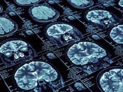 Łódź. Przełom w leczeniu raka w Szpitalu Kopernika w Łodzi! Lekarze usunęli glejaka innowacyjną metodą