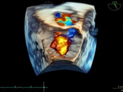 Łódź. Nowoczesny echokardiograf na Uniwersytecie Medycznym w Łodzi. Lepsza diagnostyka i leczenie